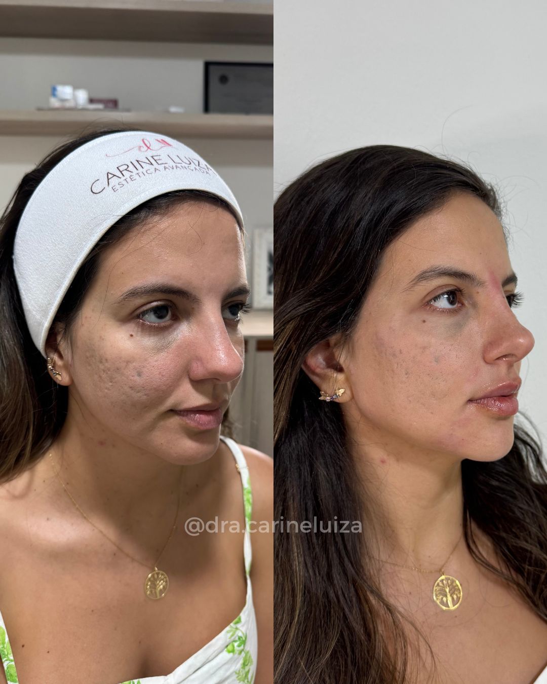 Modelo Antes e depois - Carine (1)