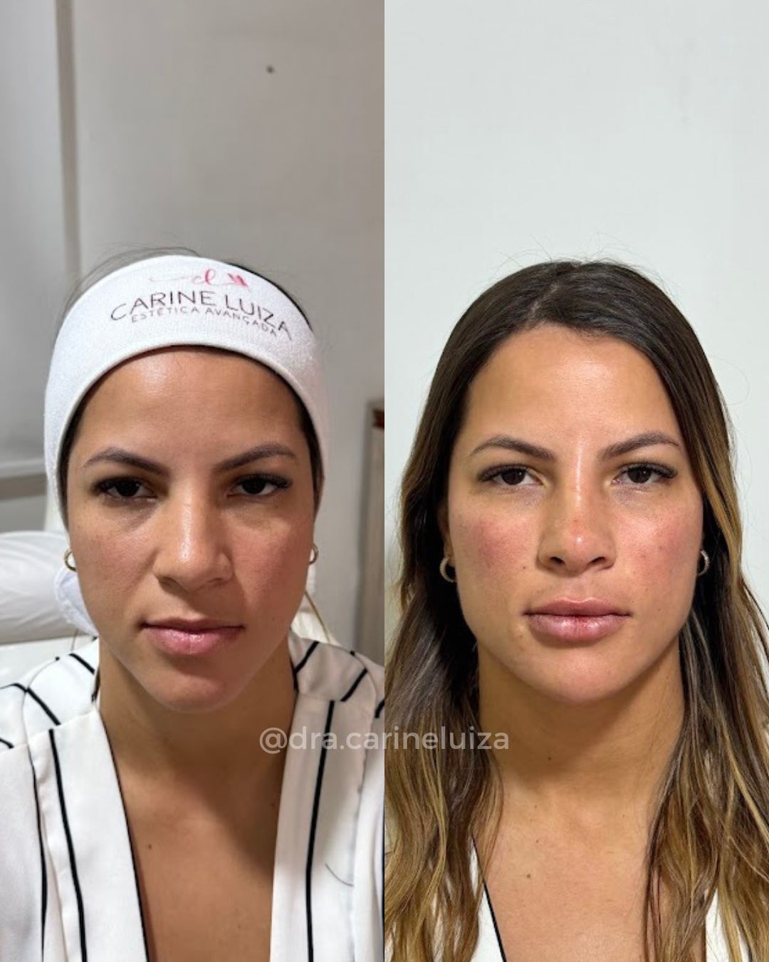 Modelo Antes e depois - Carine
